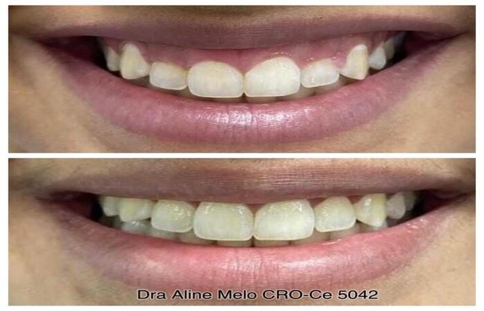 Dra-Aline-Melo-Periodontista-Cirurgia-Estética-Gengival-E-Periodontal-Dentista-Em-Fortaleza-Shopping-Salinas-Fortaleza-CE-Brazil